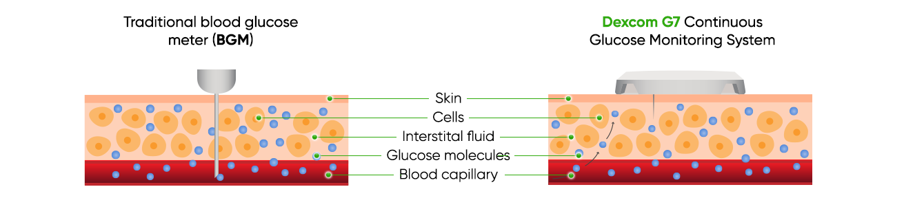 Cross-section of skin showing the differences between a BGM  fingerstick test depth and CGM sensor filament depth.